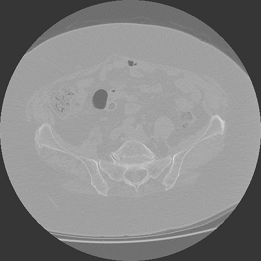 CT Becken Mitte